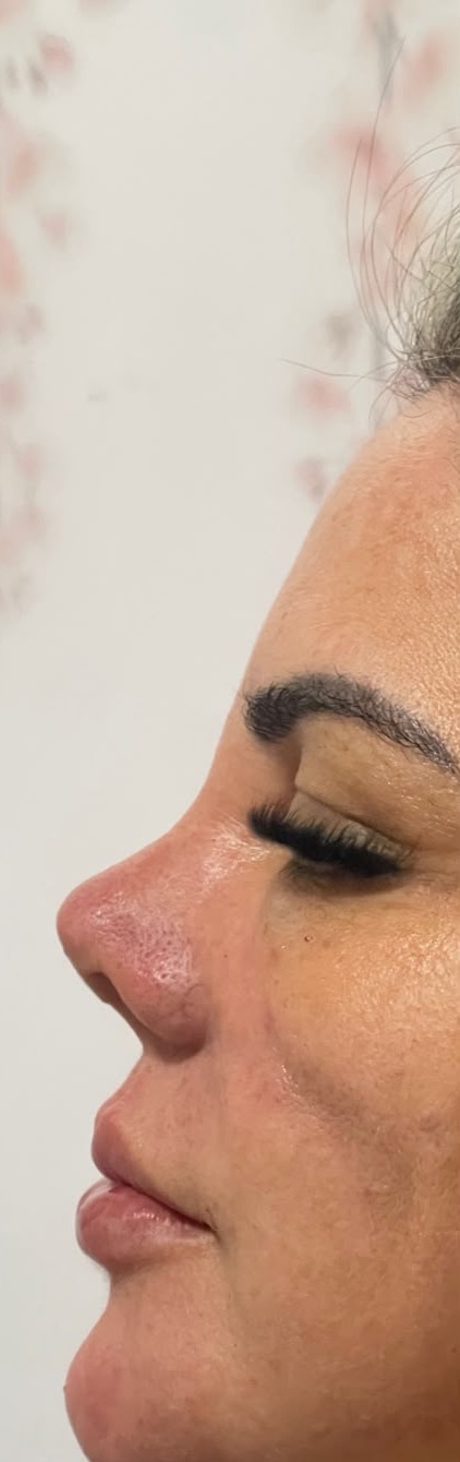 Depois do procedimento de Perfiloplastia no Instituto GDA