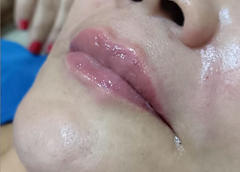 Depois do procedimento de Preenchimento Labial no Instituto GDA